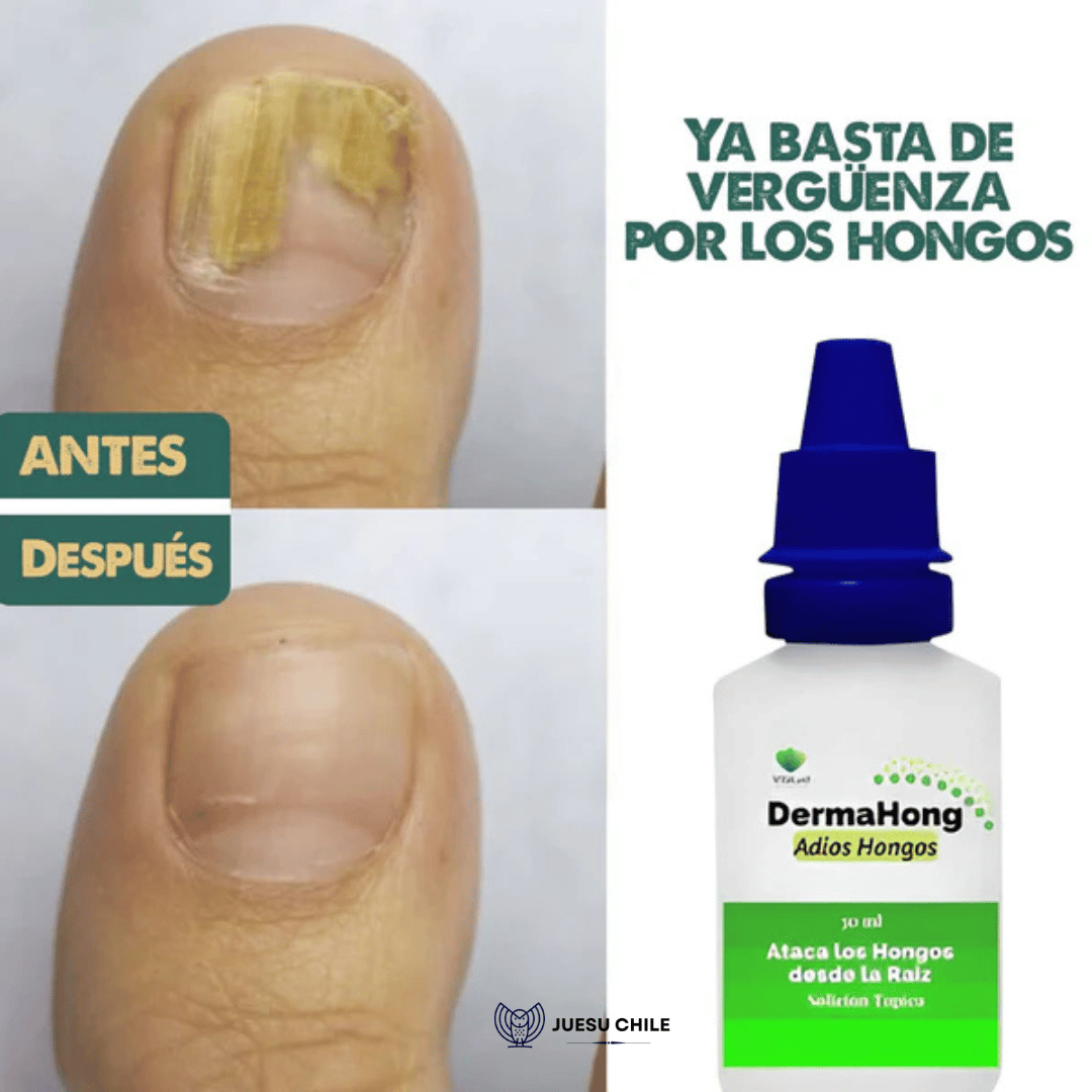 Tratamiento Mensual DermaHong-  Dile adiós a los hongos y recupera tu confianza