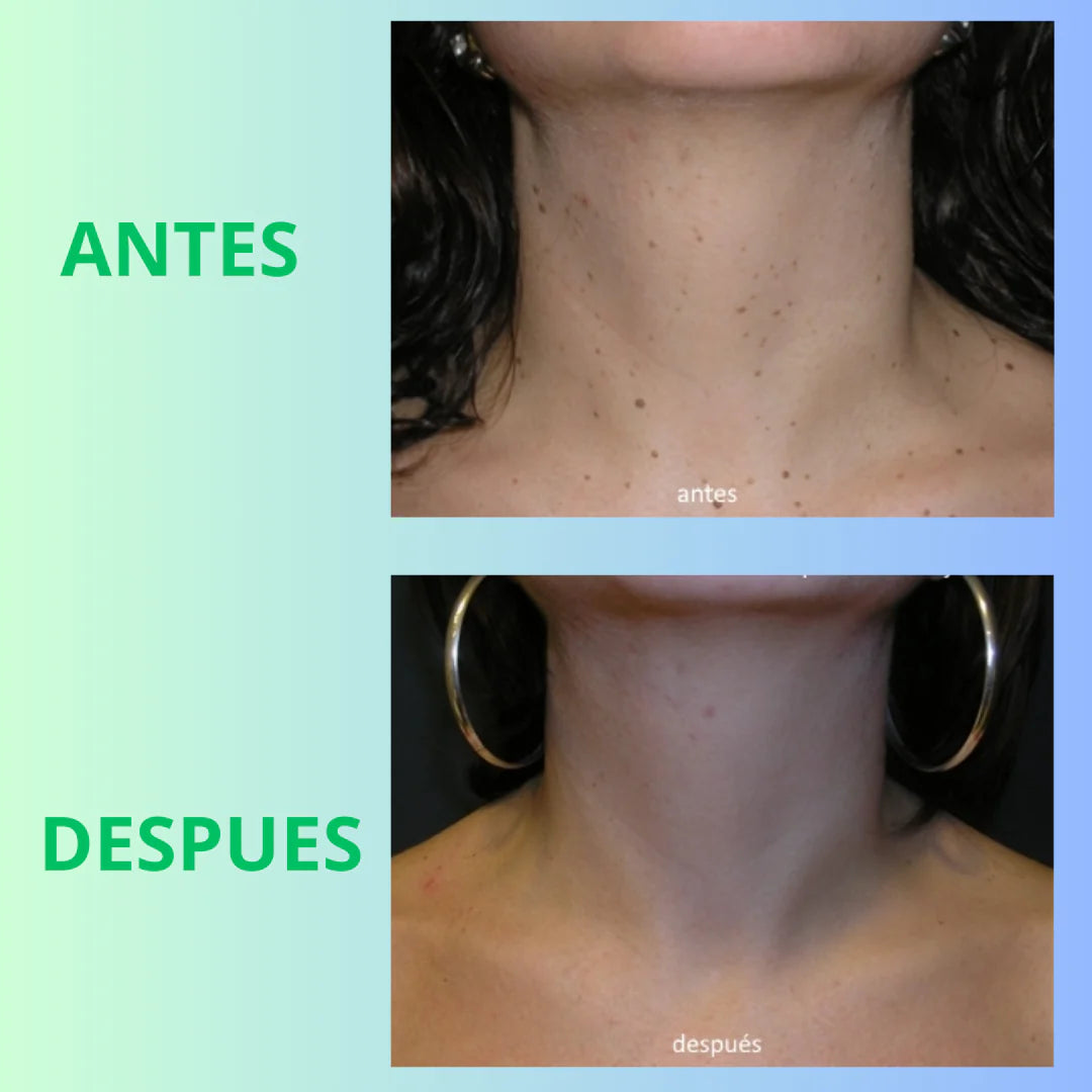 Wart Remover– Remueve Verrugas Fácil – Recupera tu confianza sin dolor en casa