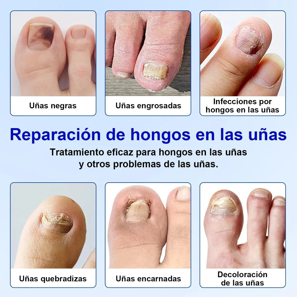 Parches ANTI-HONGO - combate hongos, aclara y refuerza tus uñas
